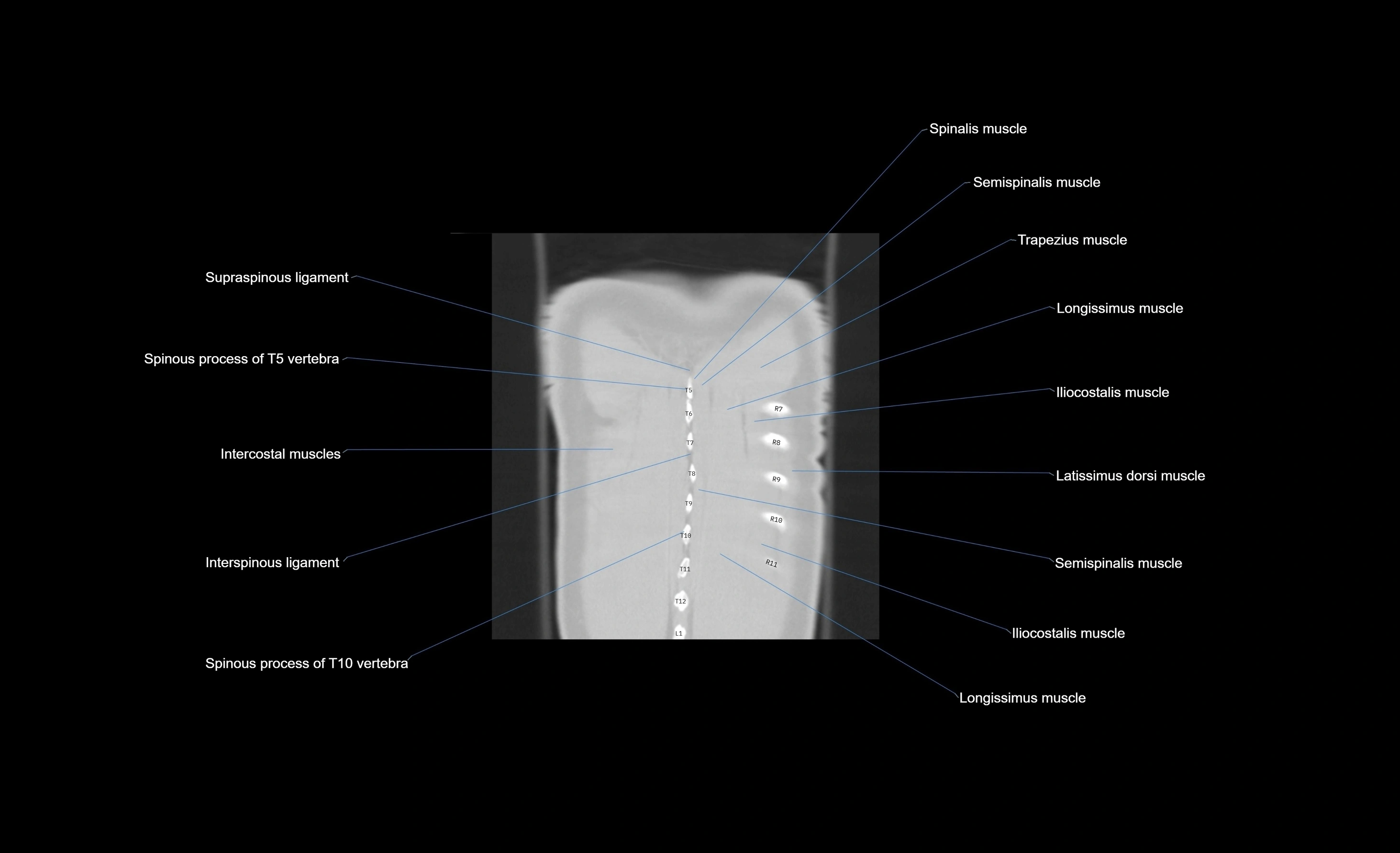 CT chest (thorax) labelled coronal cross sectional anatomy radiology image-00010.webp